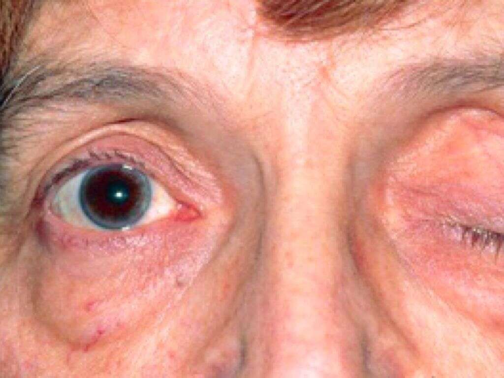 Myasthenia Gravis