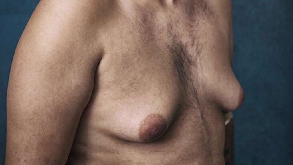 Non-Alcoholic Fatty Liver Disease