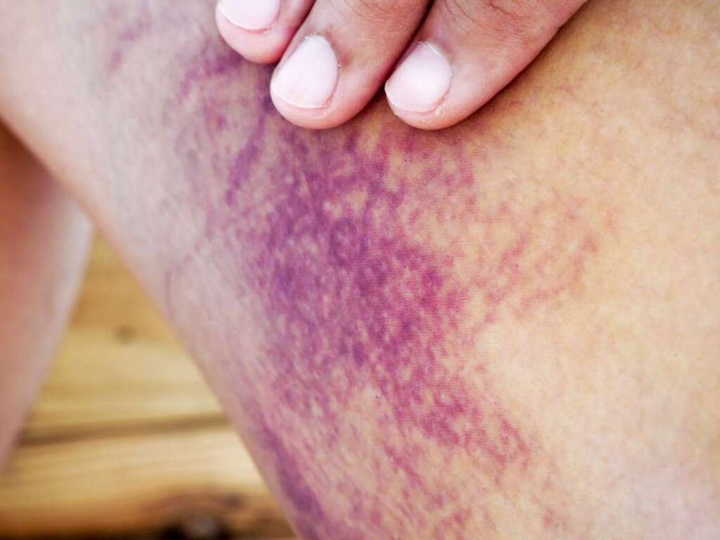 Non-Alcoholic Fatty Liver Disease