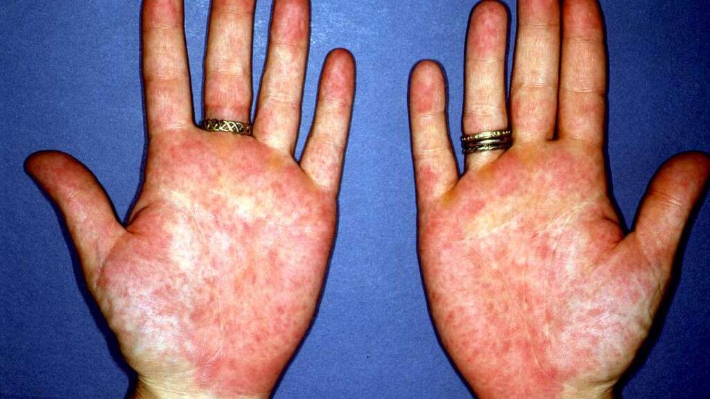 Non-Alcoholic Fatty Liver Disease