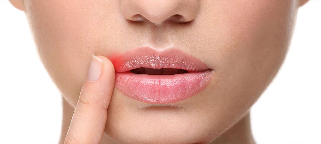 Oral Thrush