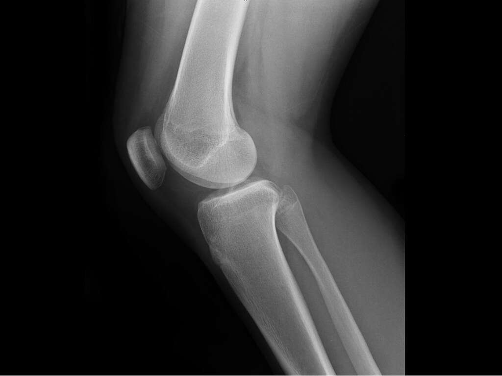 Osteoarthritis