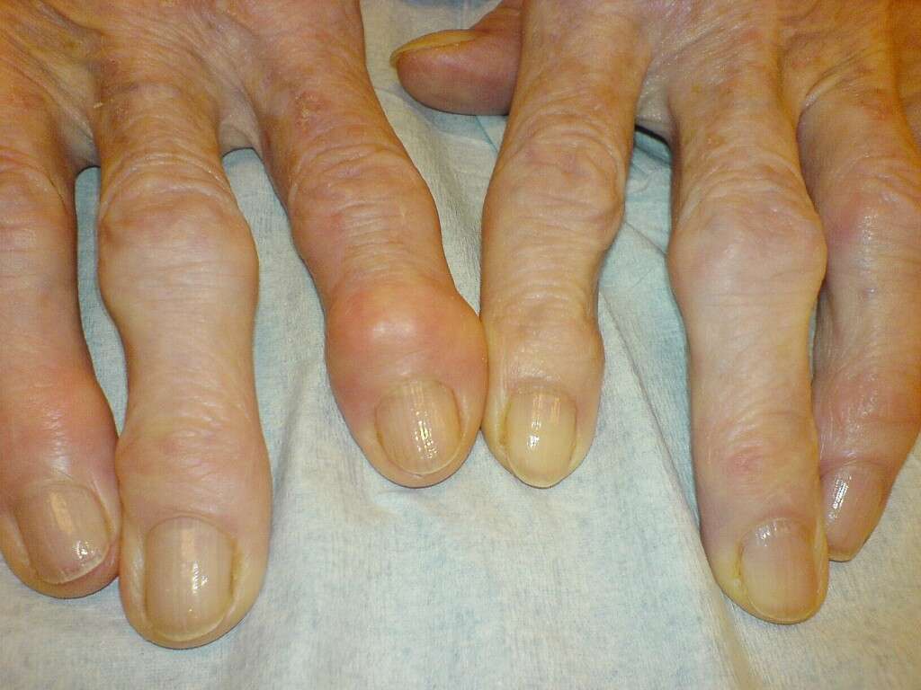 Osteoarthritis