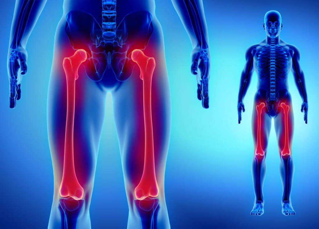 Osteosarcoma