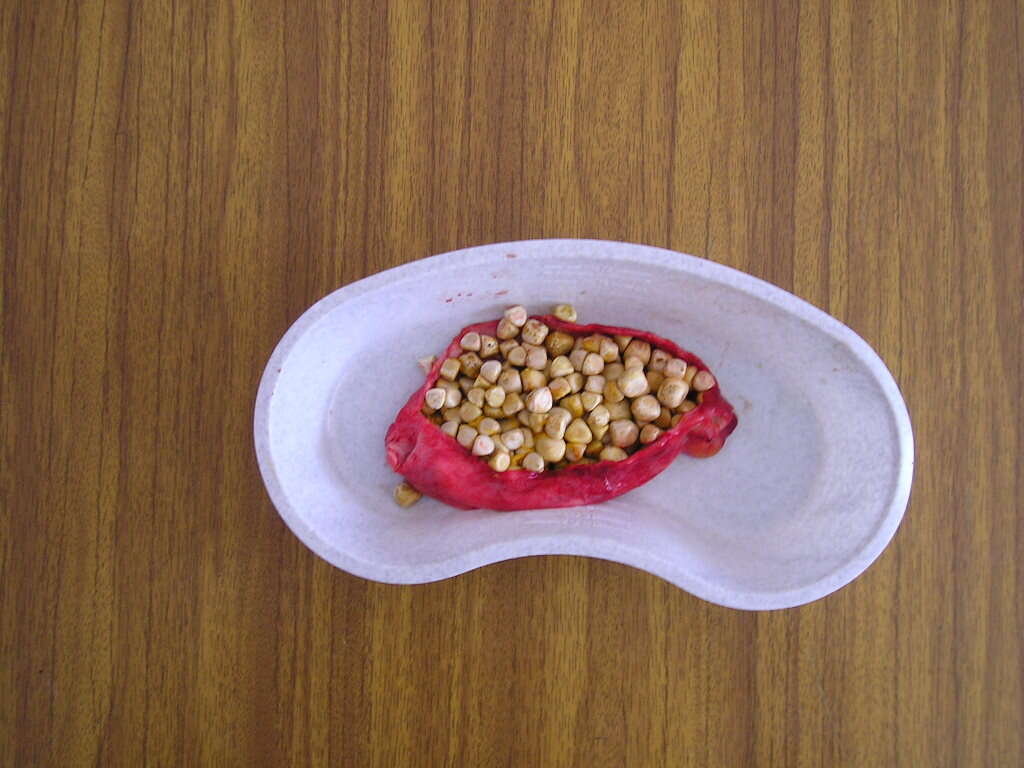 Pancreatitis