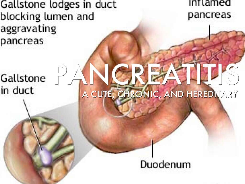 Pancreatitis