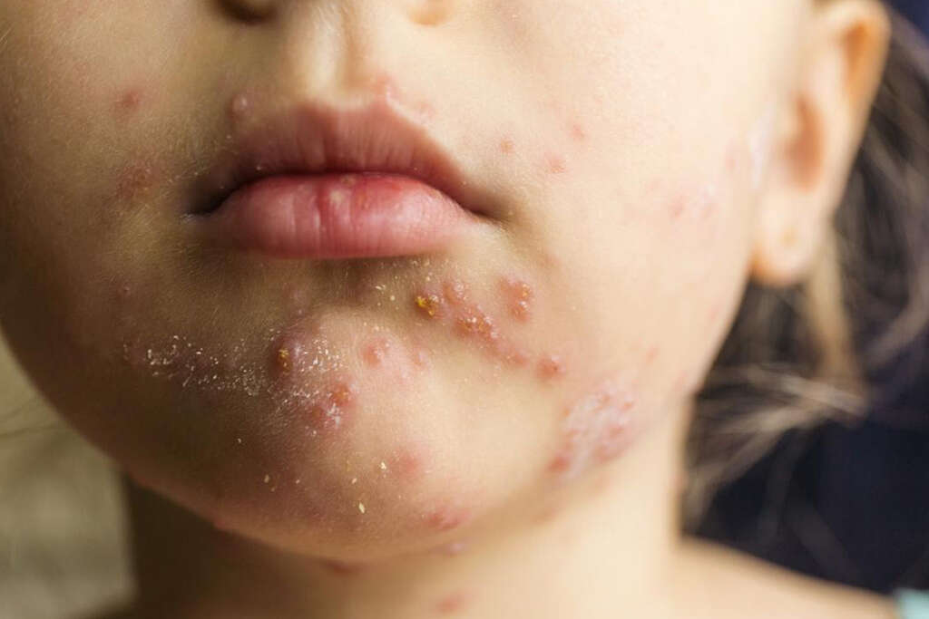 Parvovirus