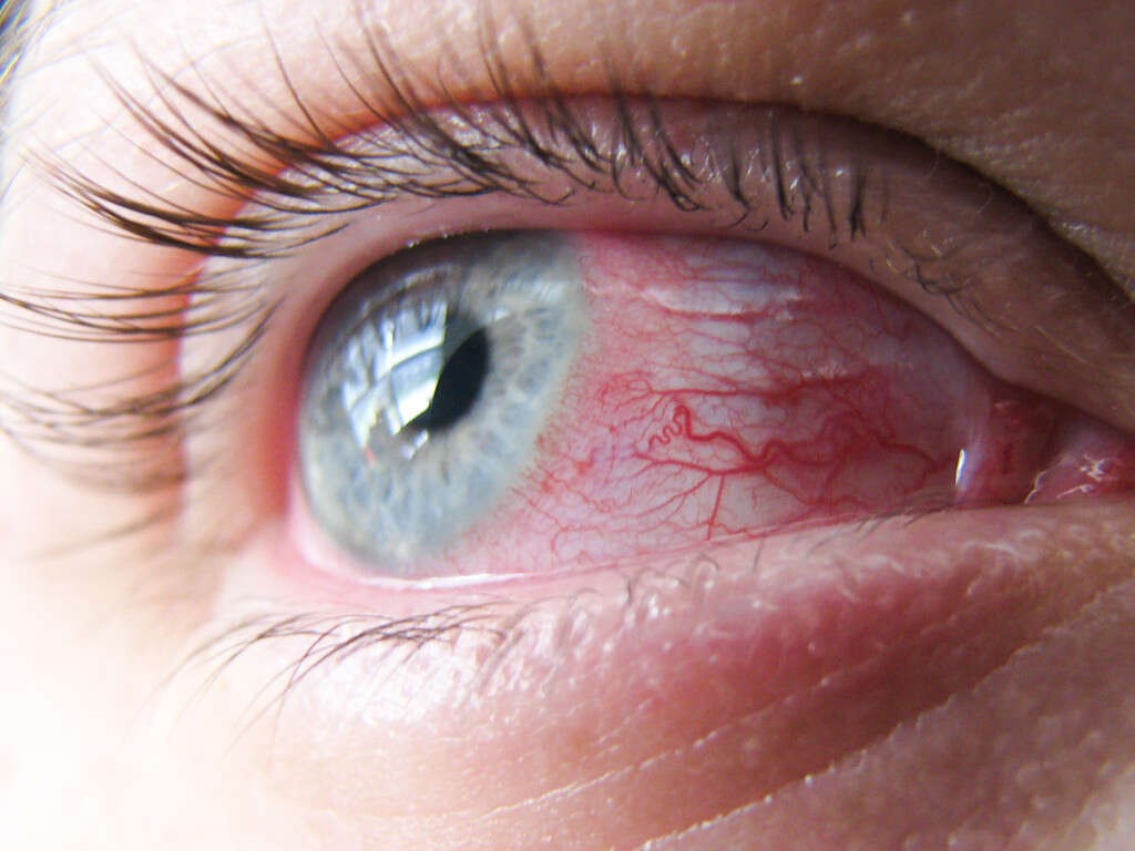 Pink Eye