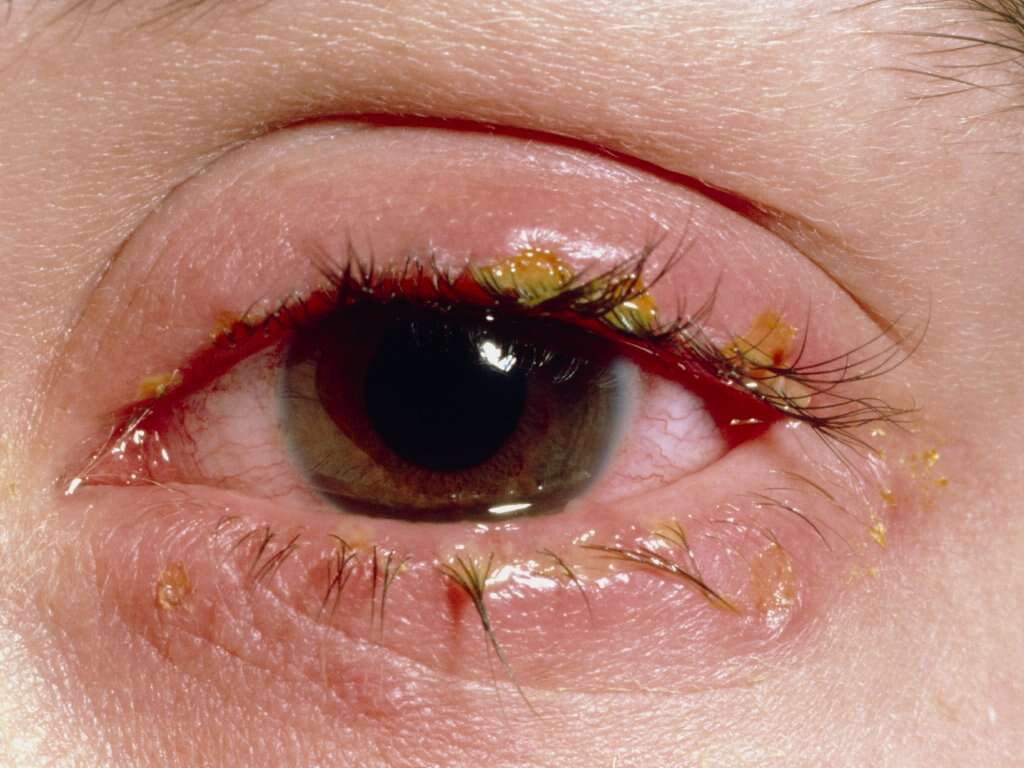 Pink Eye