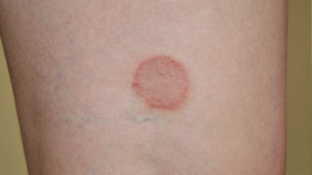 Pityriasis Rosea Facts
