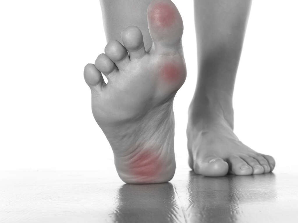 Plantar Fasciitis