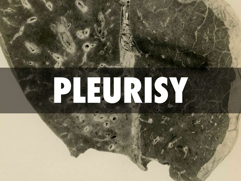 Pleurisy