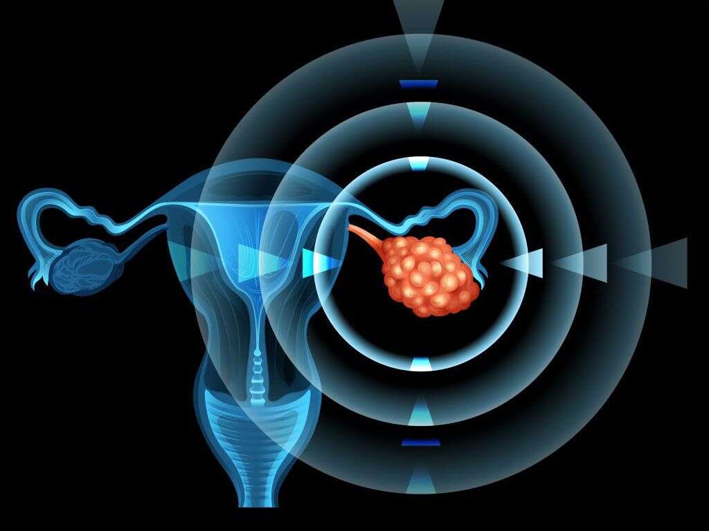 Polycystic Ovary Syndrome