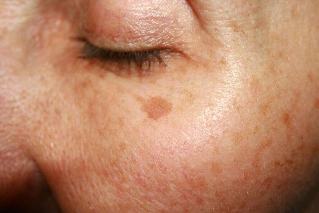 Polycystic Ovary Syndrome