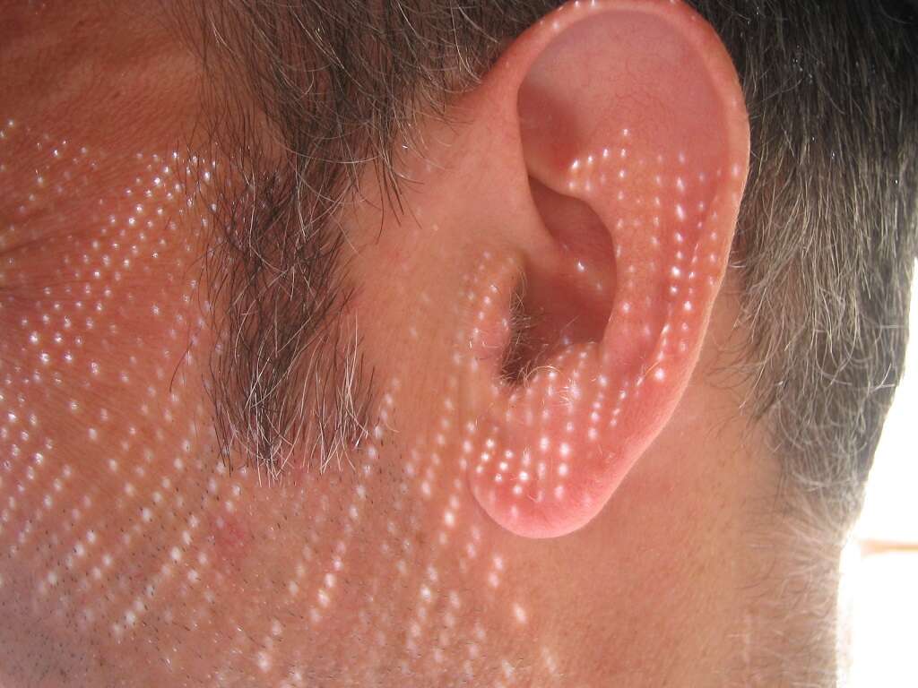 Polyps