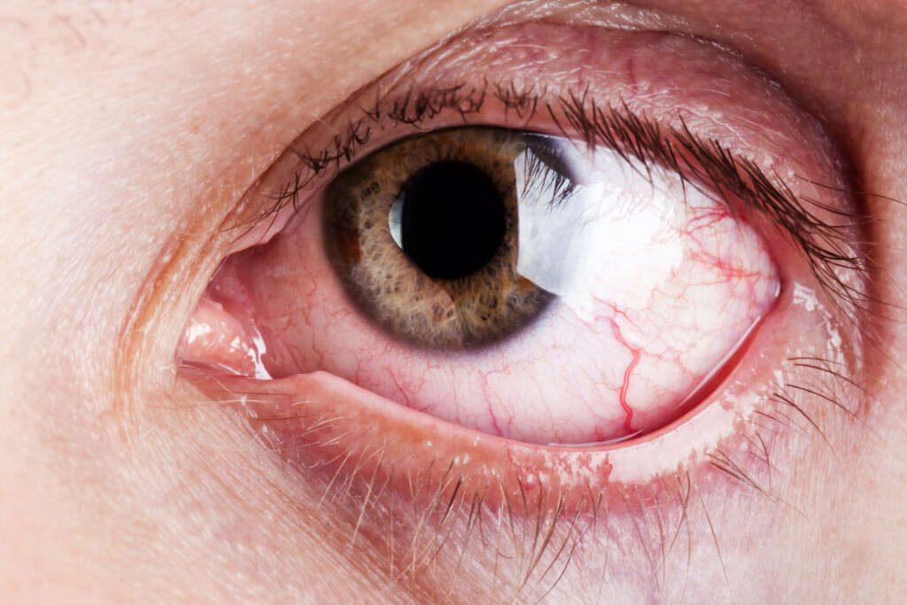 Retinal Detachment