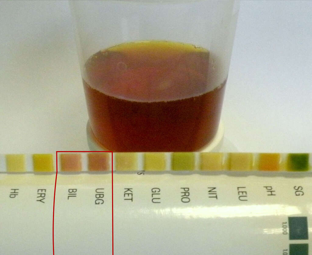 Rhabdomyolysis