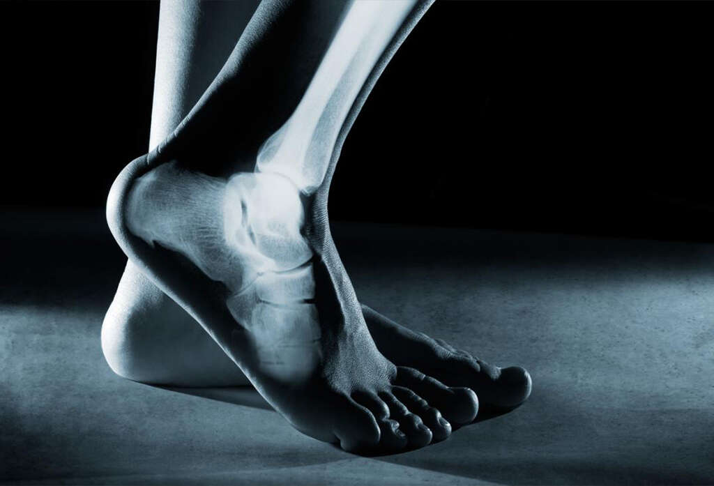 Rickets