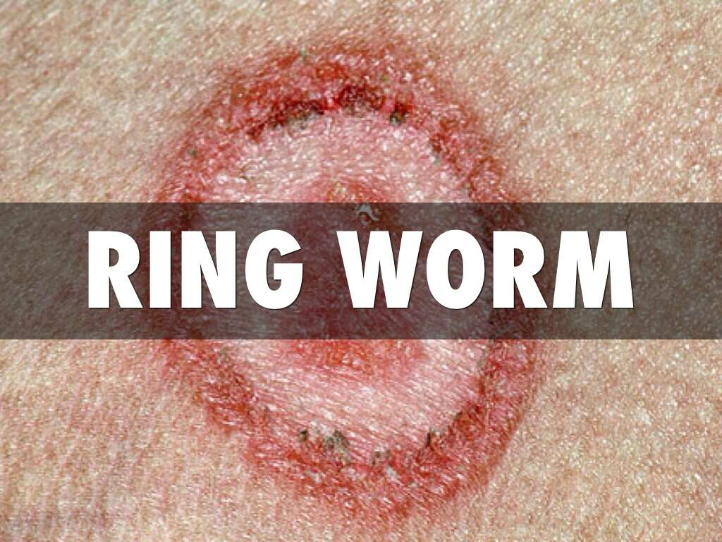 Ringworm