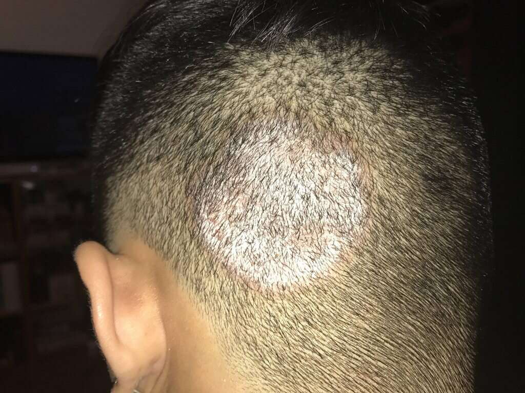 Ringworm