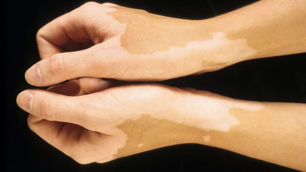 RSD (Reflex Sympathetic Dystrophy)(Reflex Sympathetic Dystrophy)
