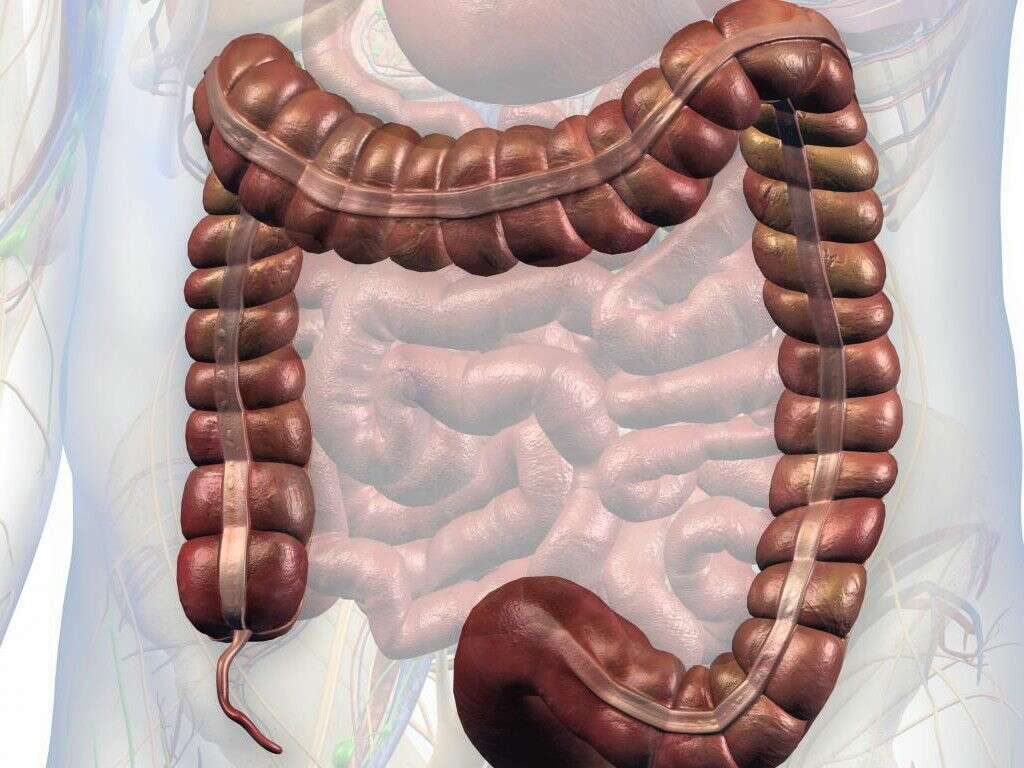 Ruptured Appendix