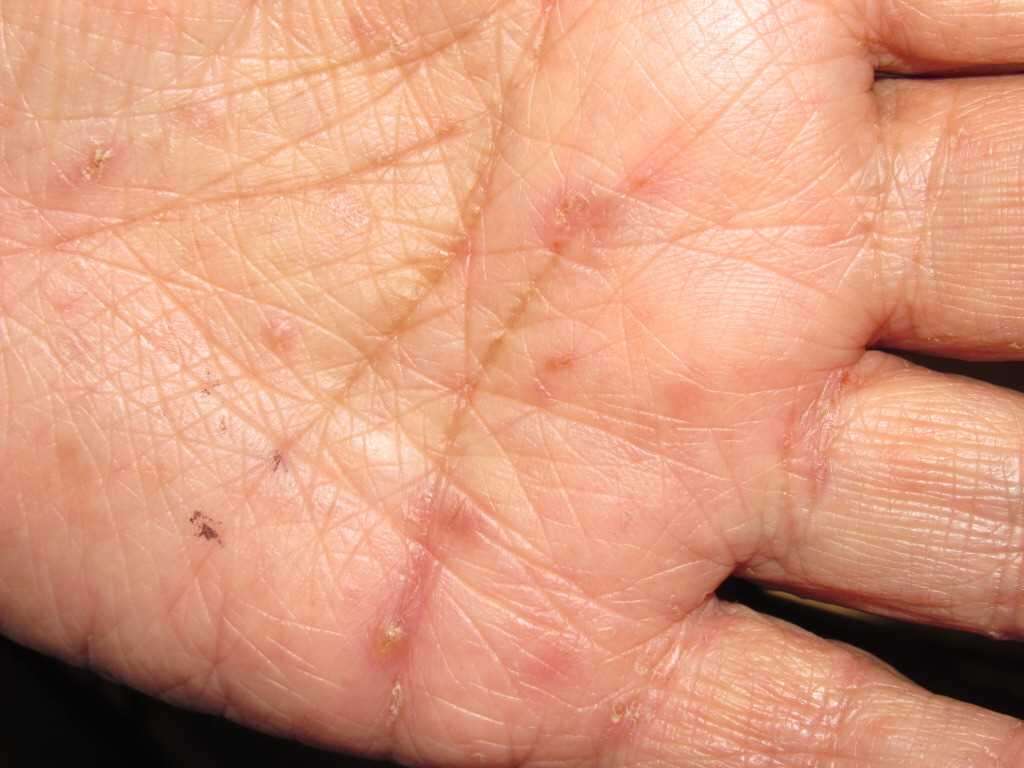 Scabies