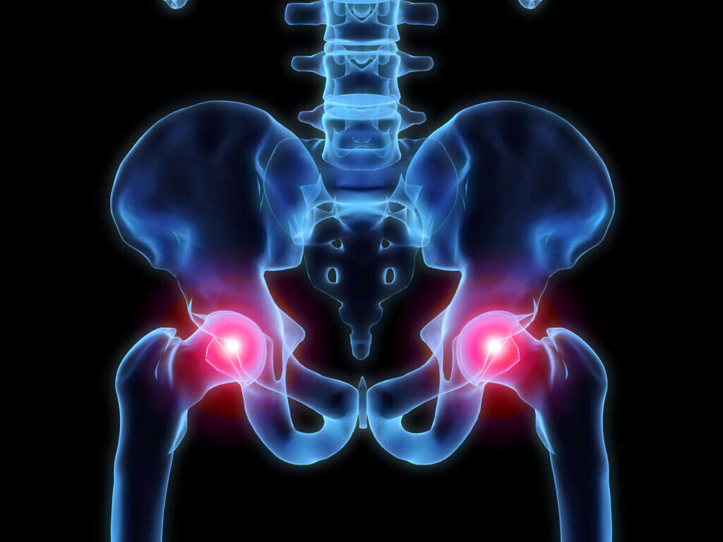 Sciatica