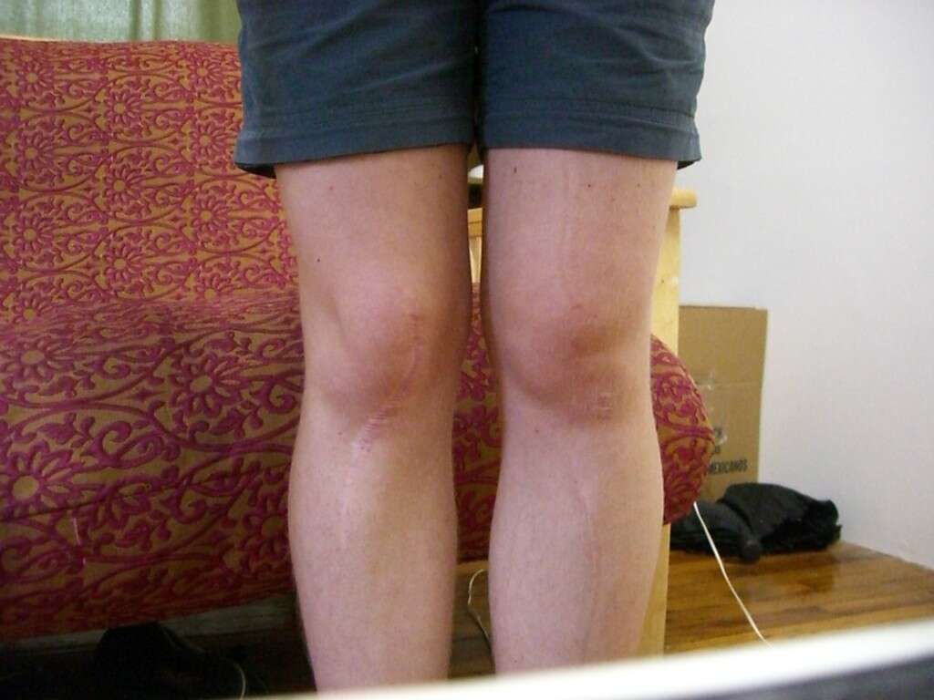 Sciatica