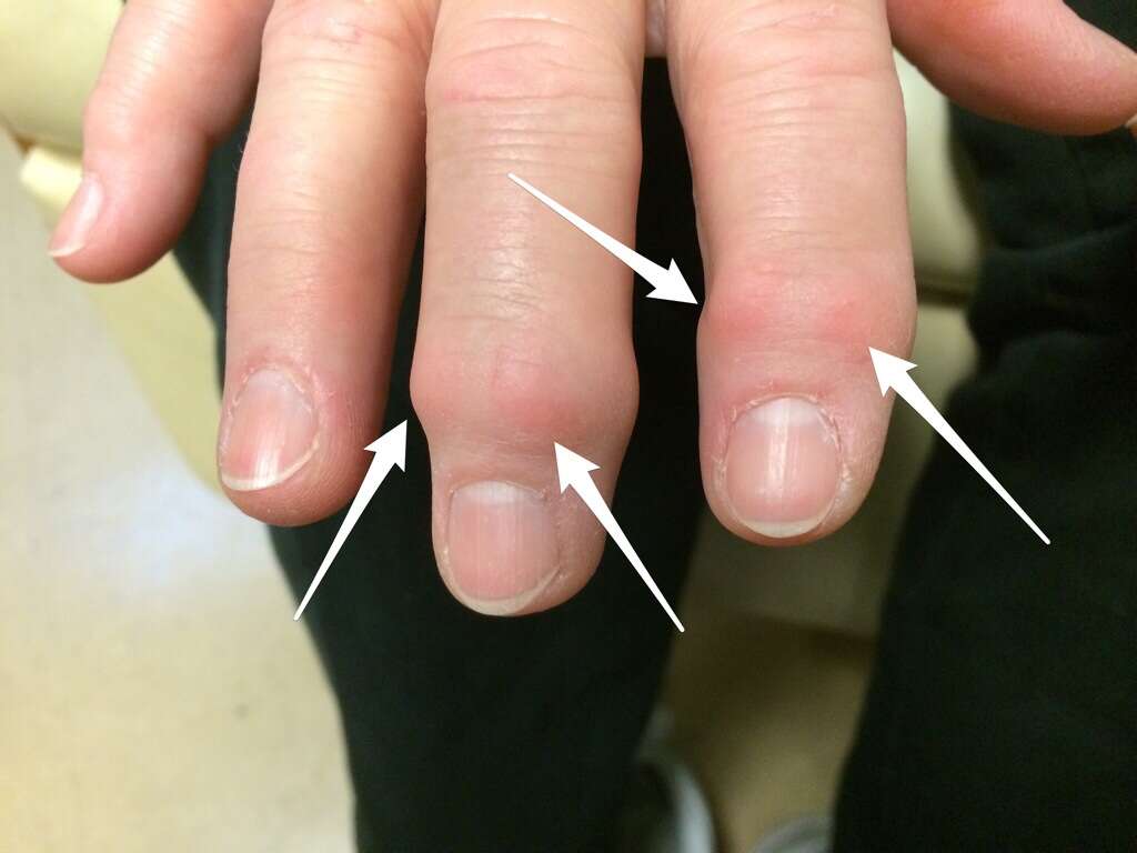 Scleroderma