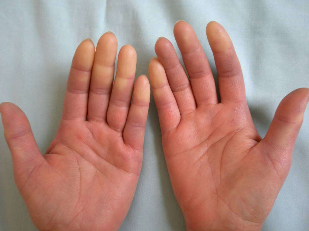 Scleroderma