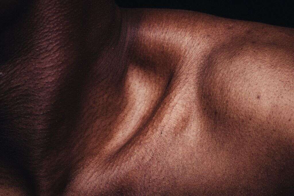 sebaceous cyst