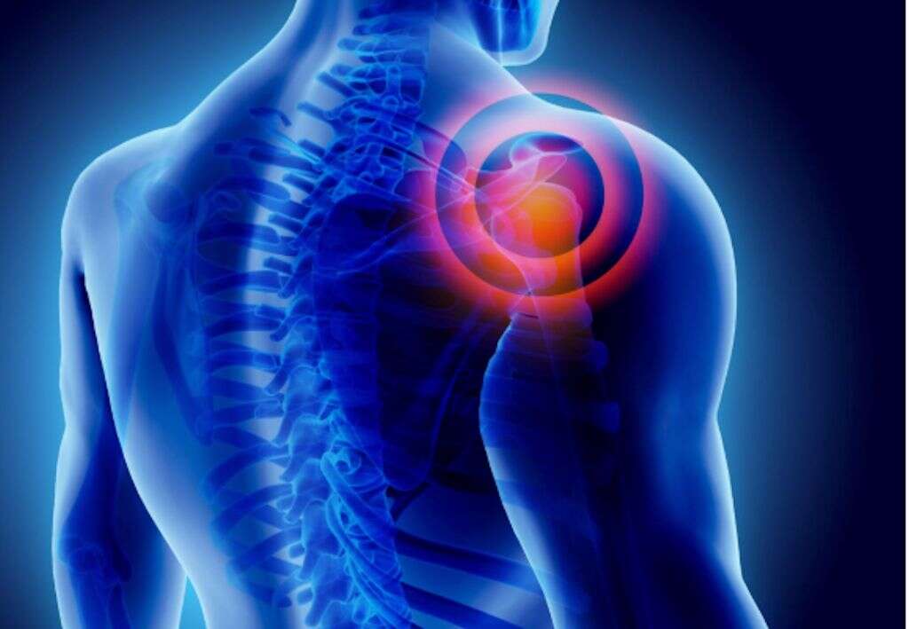 Shoulder Impingement