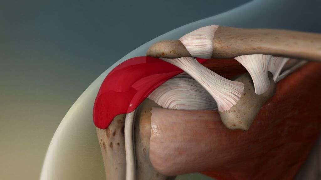 Shoulder Impingement