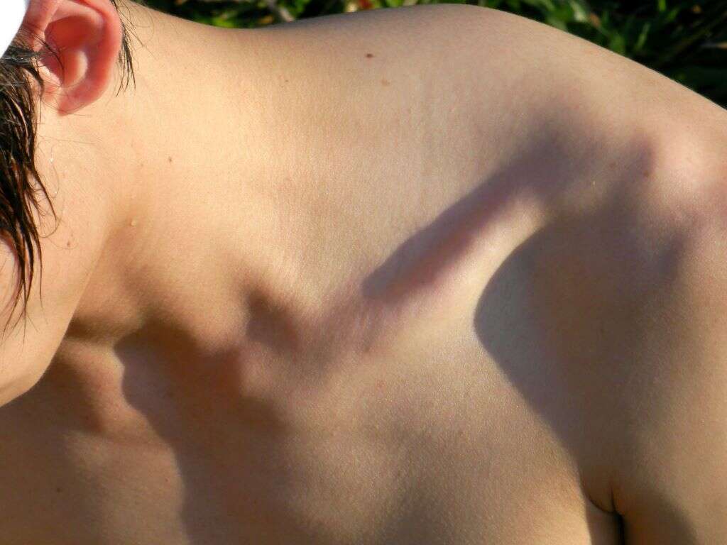 shoulder pain