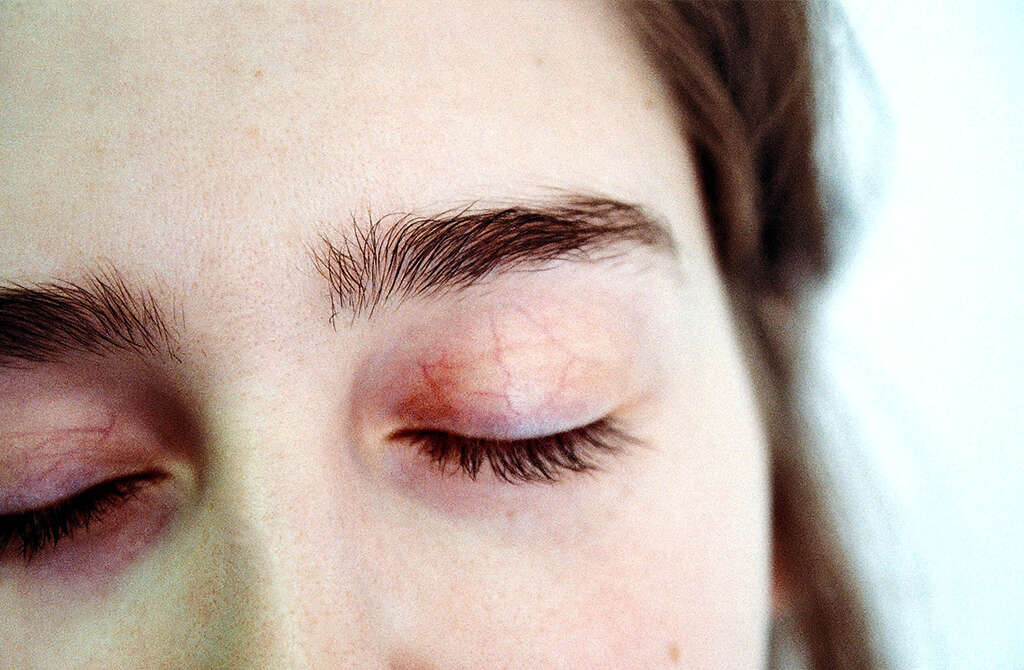 Sickle Cell Anemia