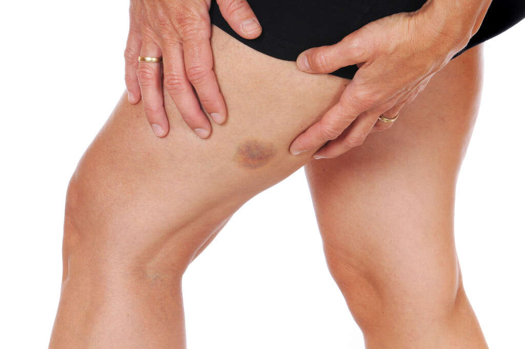 Blood Clot In Leg