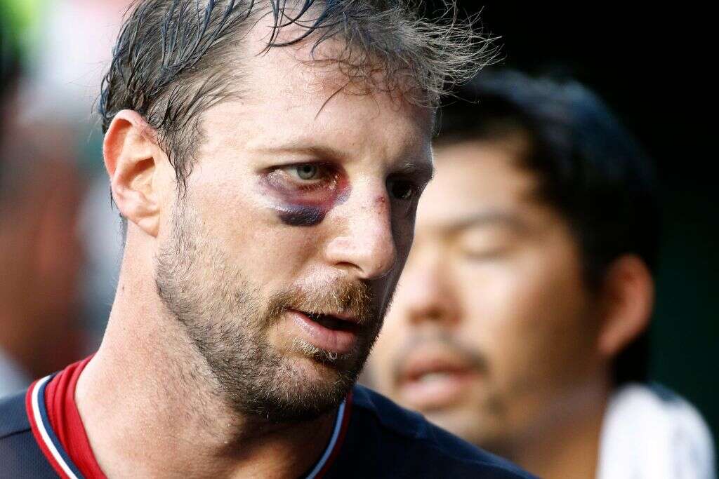 Broken Nose