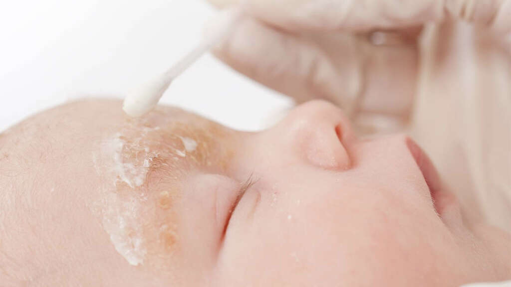 Dehydration In Toddlers