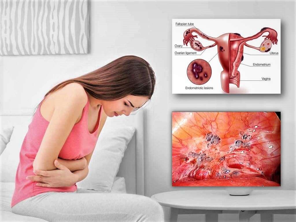 Endometriosis