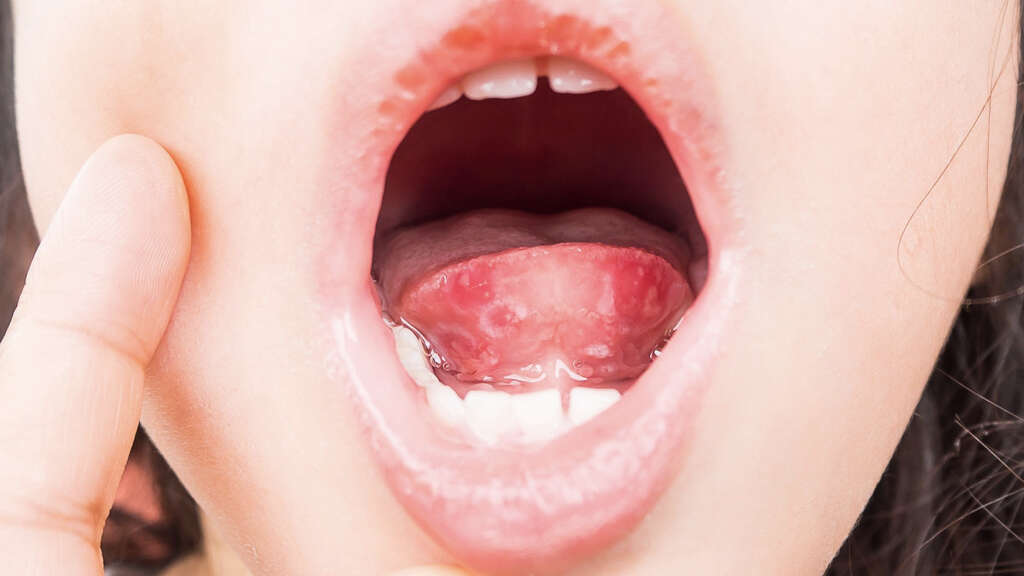 Strep