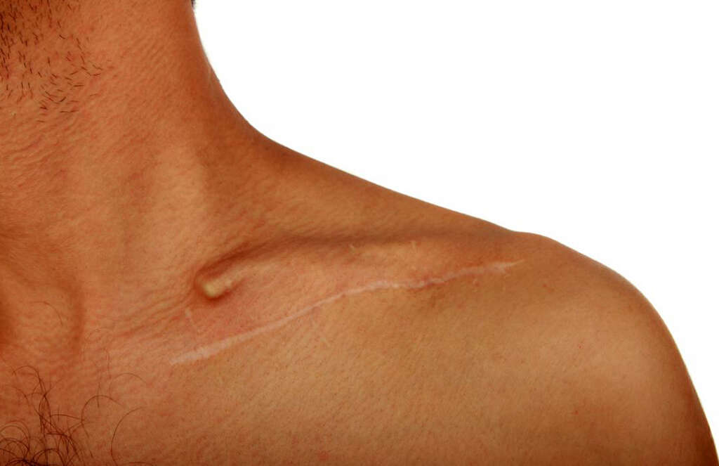 Skin Cancer