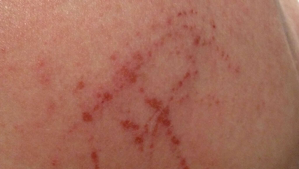 Skin Cancer