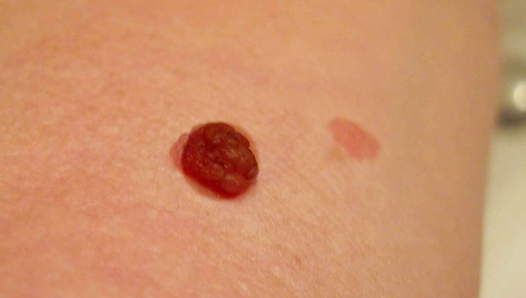 Skin Cancer