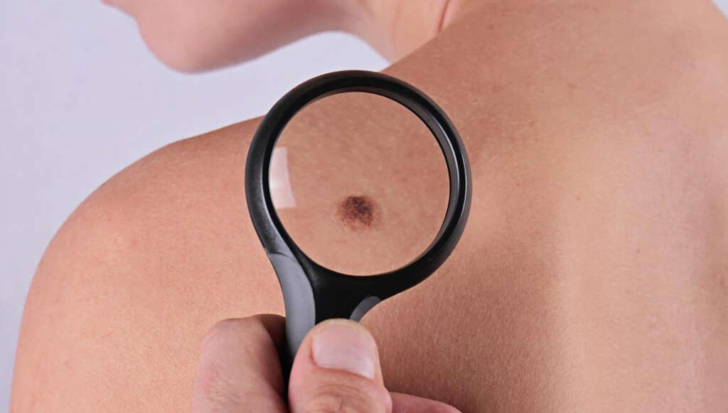 Skin Cancer