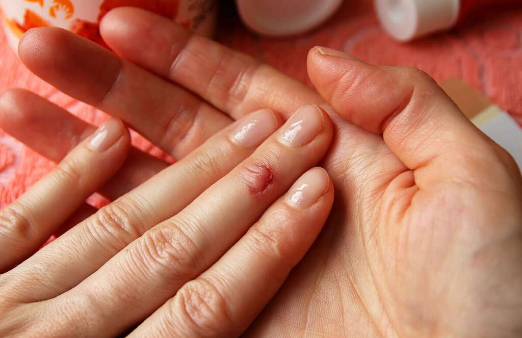 Skin Cancer