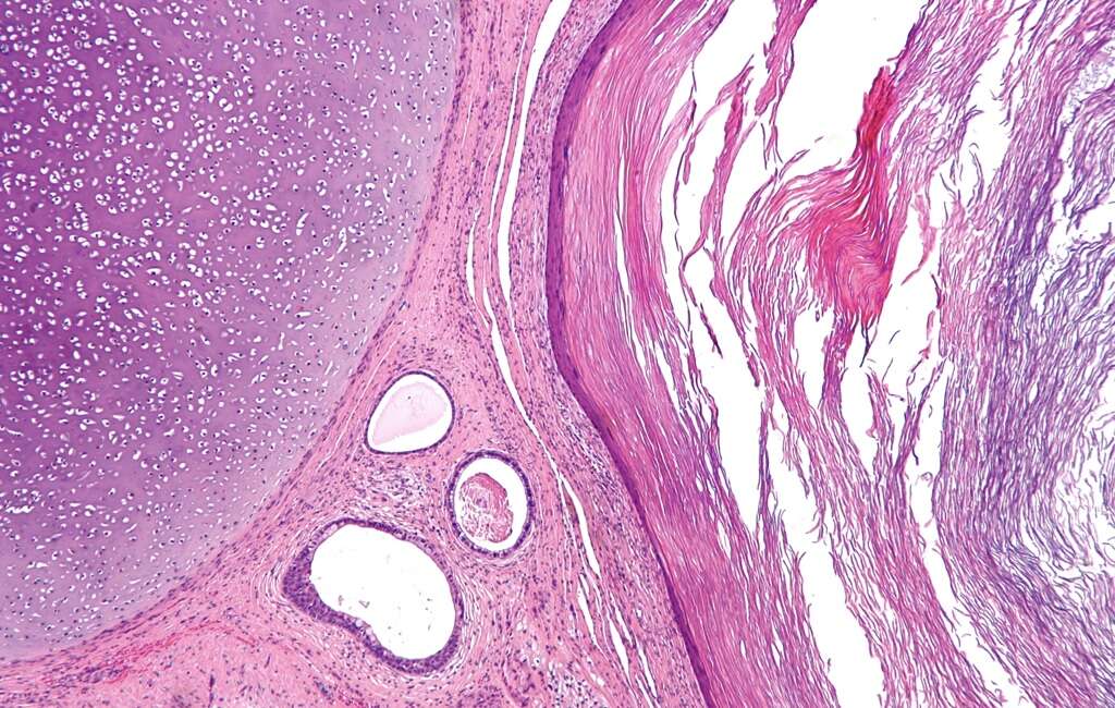 Spina Bifida