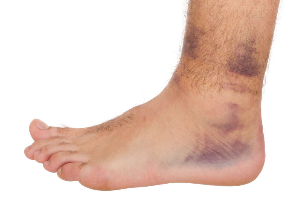 Sprained Ankle