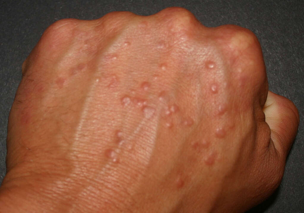 Squamous Cell Carcinoma