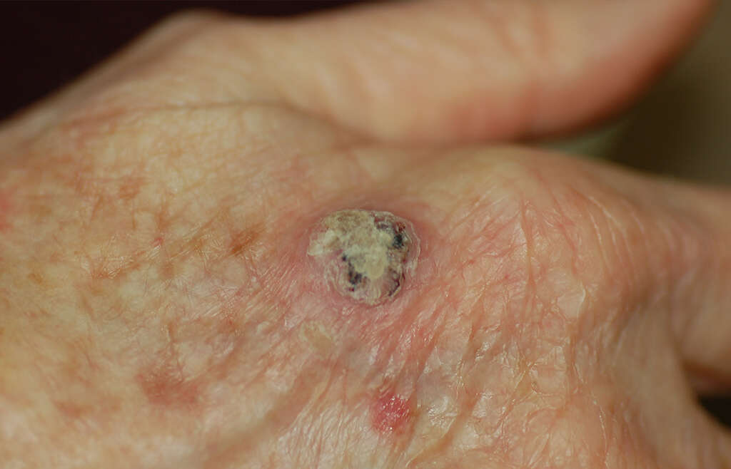 Squamous Cell Carcinoma